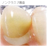 ノンプラヅプ義歯001-1.jpg