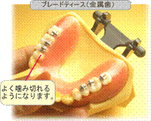 良く噛める入れ歯～ブレードティース – 飯嶋歯科医院（埼玉県本庄市