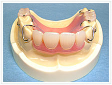 金属バネ義歯