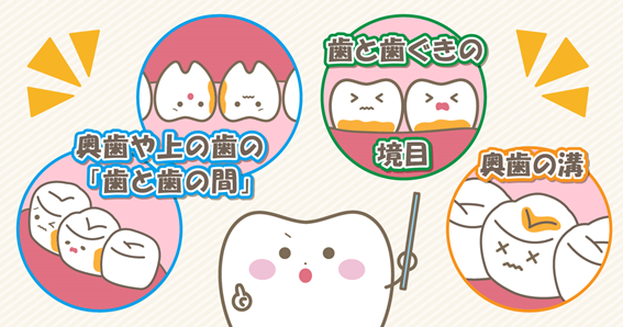 むし歯になりやすいところ
