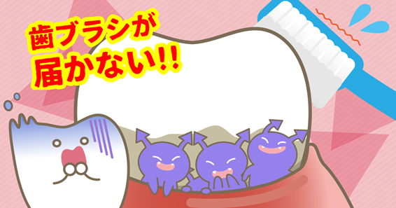 歯と歯ぐきの「みぞ」