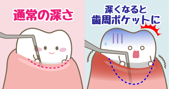 歯周ポケット