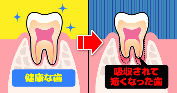歯根吸収 歯根吸収