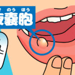 子供に多いお口の病気・・・その２