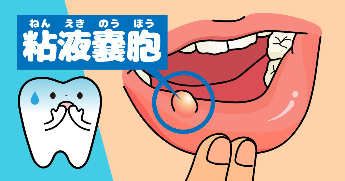 粘液嚢胞（ねんえきのうほう）