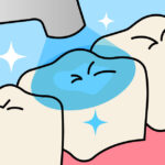 保険でできる白い詰め物（CR）とは②