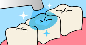 保険でできる白い詰め物（CR）とは②