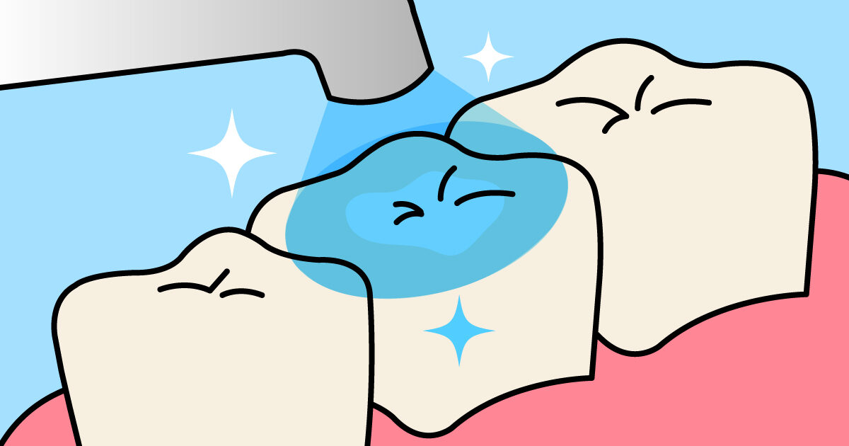 CR（コンポジットレジン）