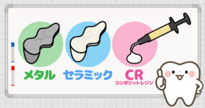 保険でできる白い詰め物（CR）とは④
