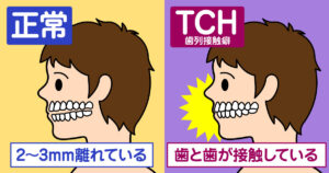 話題のスマホで顎関節症になる　その２