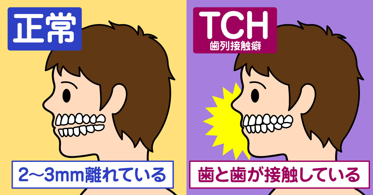 TCH（歯列接触癖）