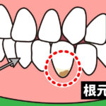 歯肉が下がったら要注意　その２