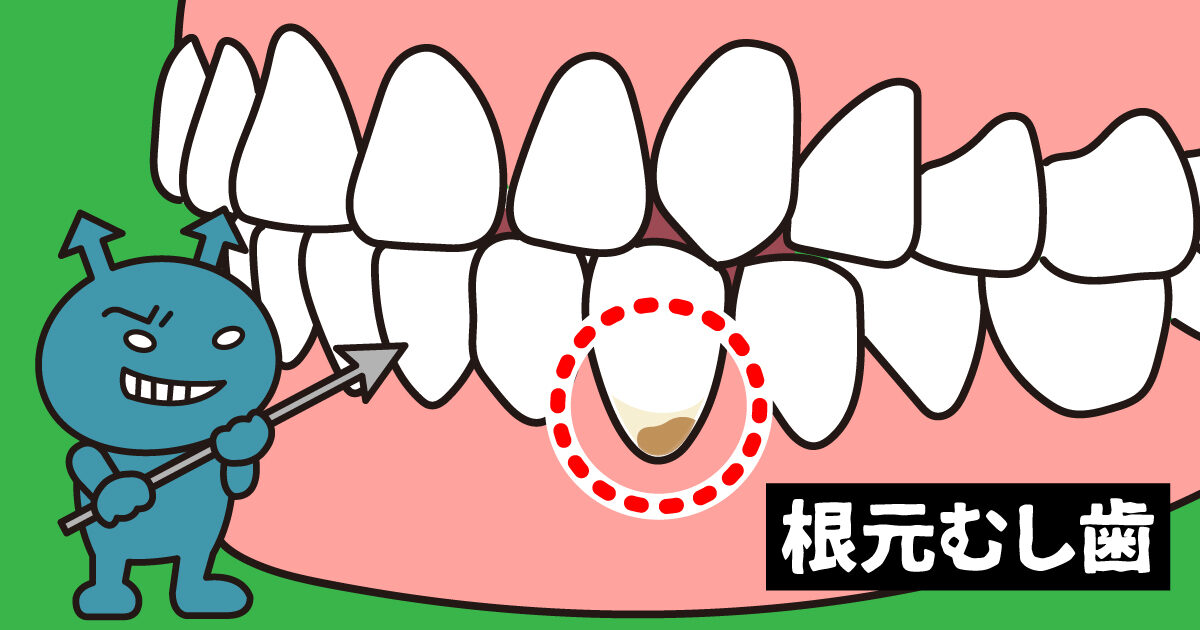根元むし歯 根元むし歯